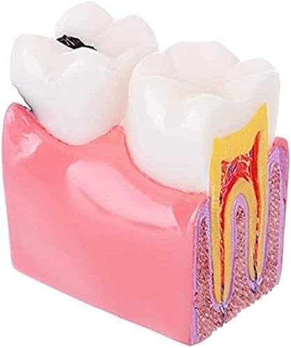 RRGJ model za nastavu, zubne model za obrazovanje zuba za zube za zube i istraživanje 6 puta karijes Uporedni studijski modeli 1pc